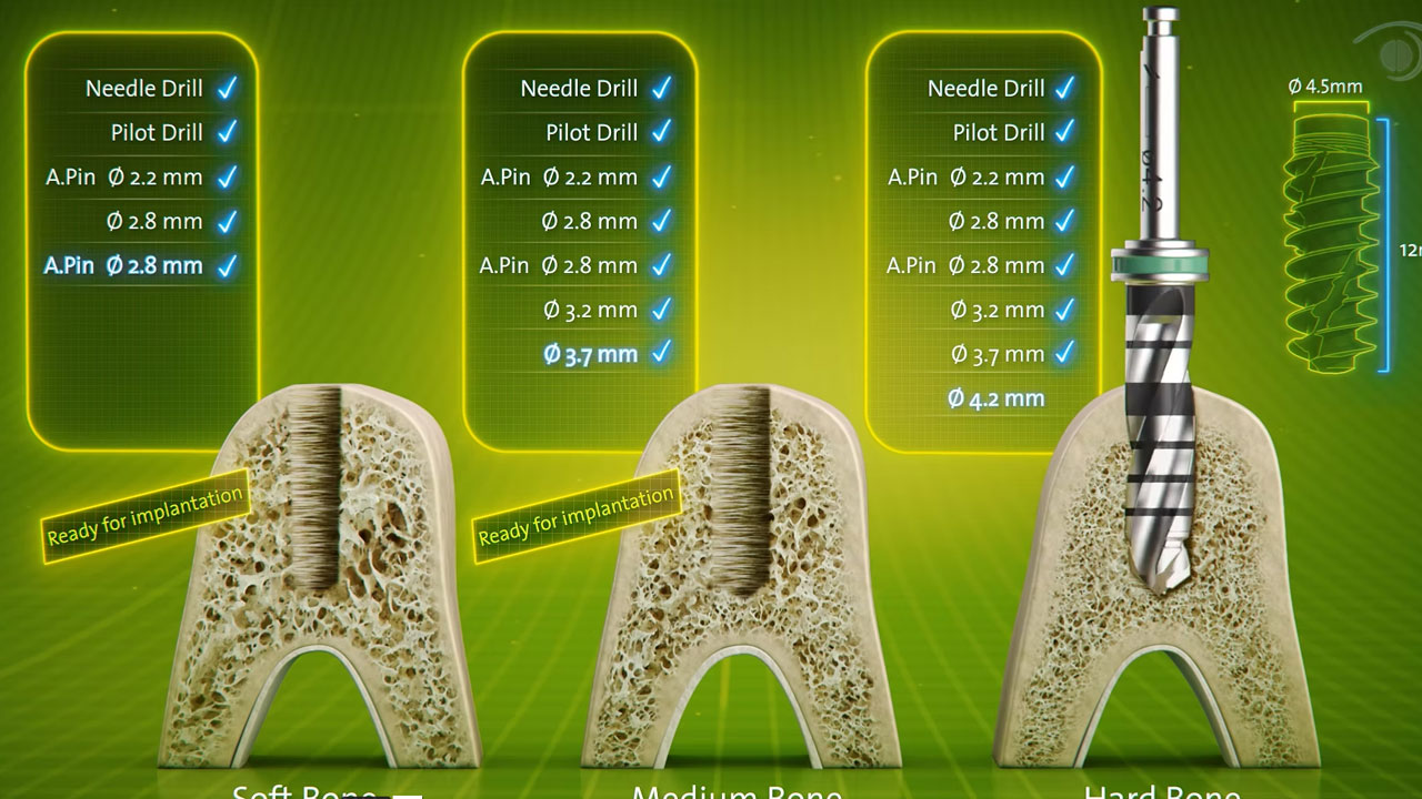 Straumann · Dental implants — BLX Drilling Protocol