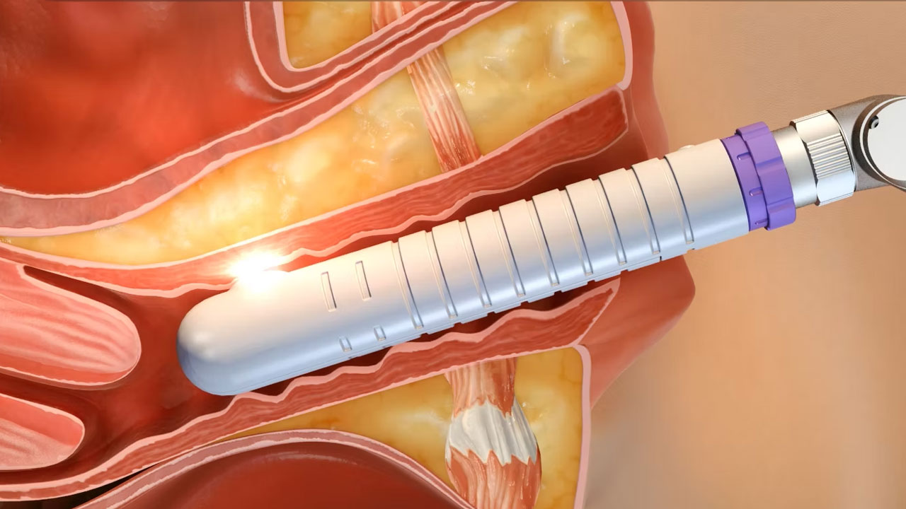 Syneron-Candela · Aesthetic laser — Core Intima